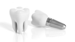 dental-implants-300x169 dental implant