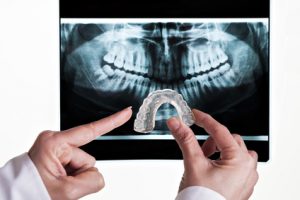 dental-x-ray-300x200 dental xray