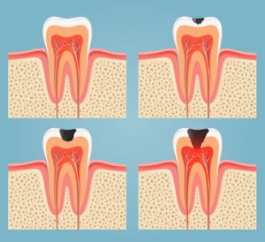 root-canal-treatment-300x274 root canal treatment