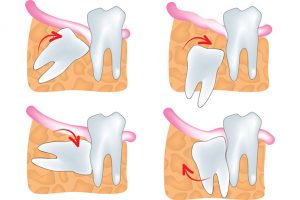 wisdom-teeth-300x200 wisdom-teeth