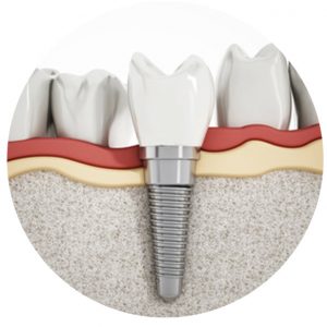 Dental-Implants-kits-300x300 Dental-Implants-kits